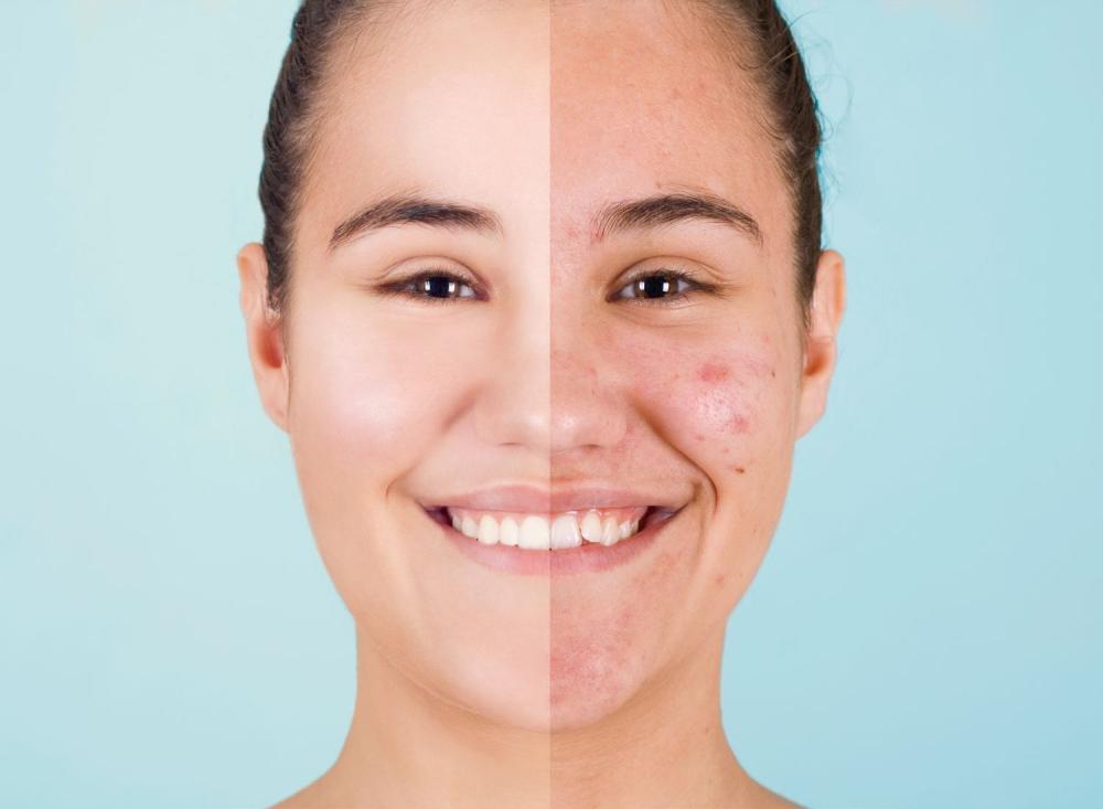 SP procura voluntários para testar novo tratamento de acne com luz azul e gel de curcumina / Foto: Divulgação